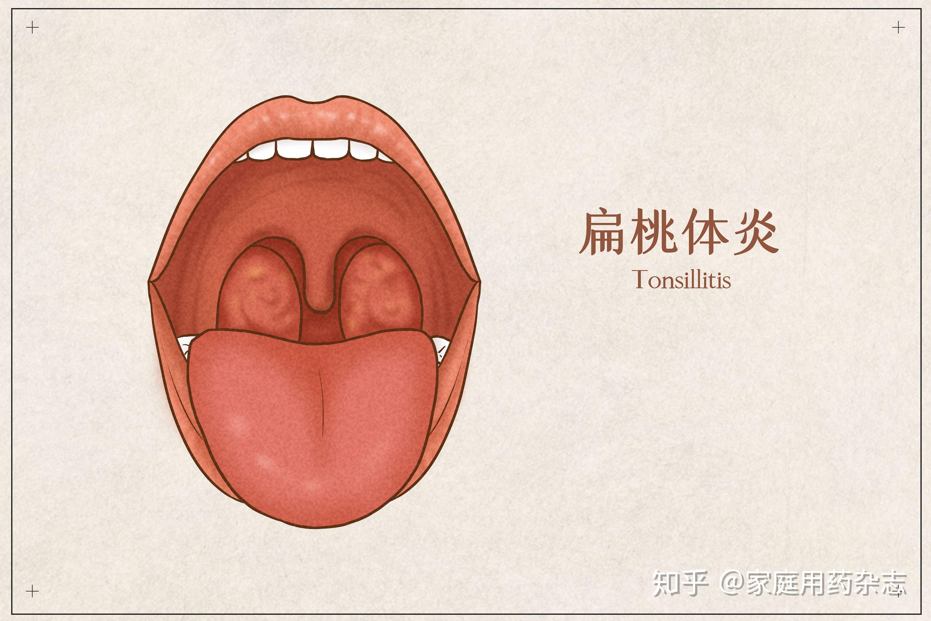 双侧扁桃体肿大一般是扁桃体炎症