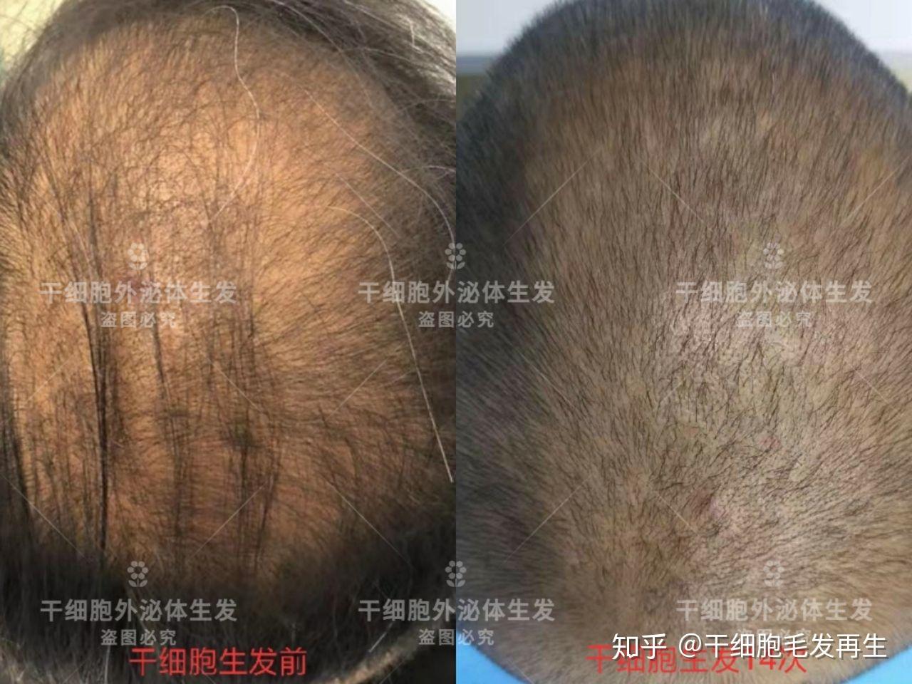 这些成功案例，告诉你什么是真正的生发黑科技 - 知乎