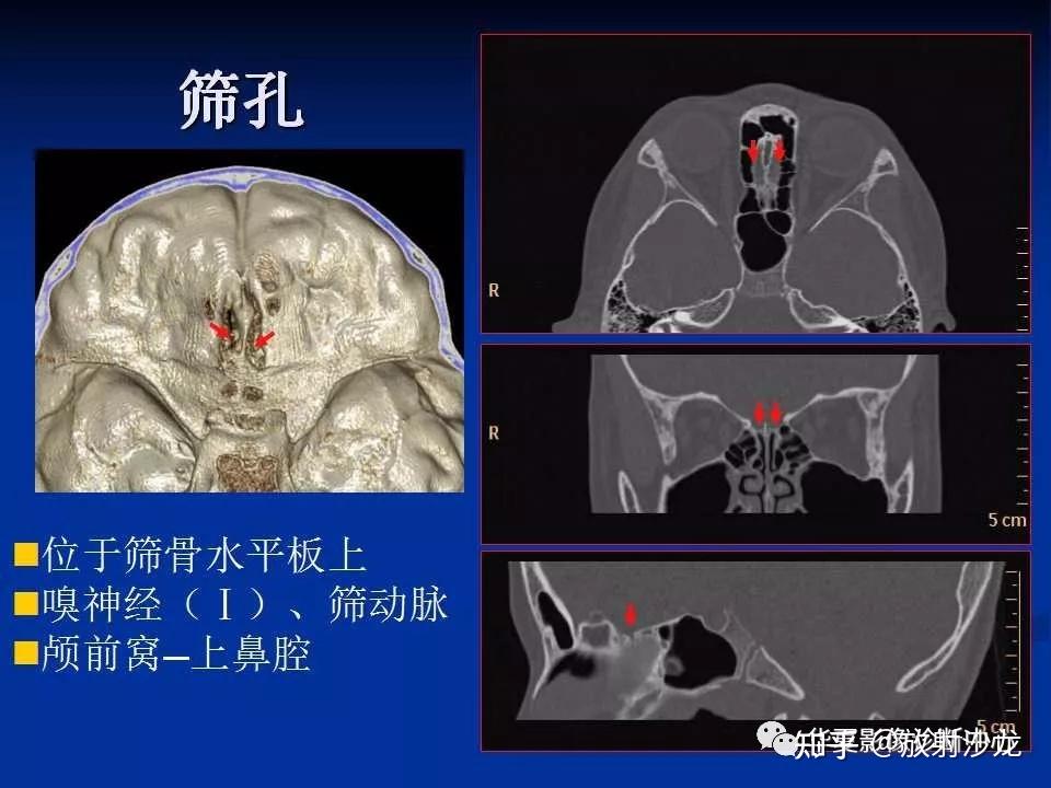 實用詳細的顱底各孔道影像解剖