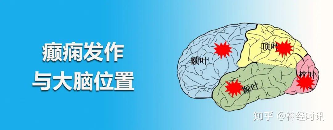 『颞叶、枕叶、顶叶、额叶』四个大脑叶区癫痫发病的区别 - 知乎