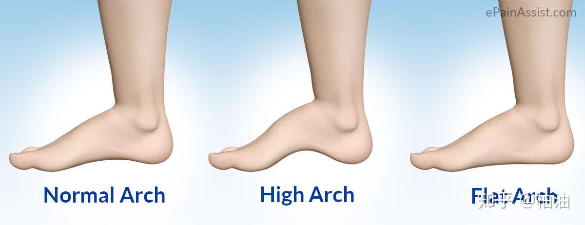 high arch feet hurt ankles
