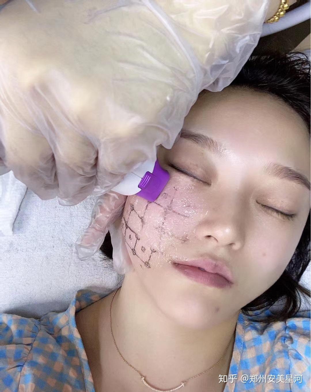 小仙女做完热玛吉后即刻效果