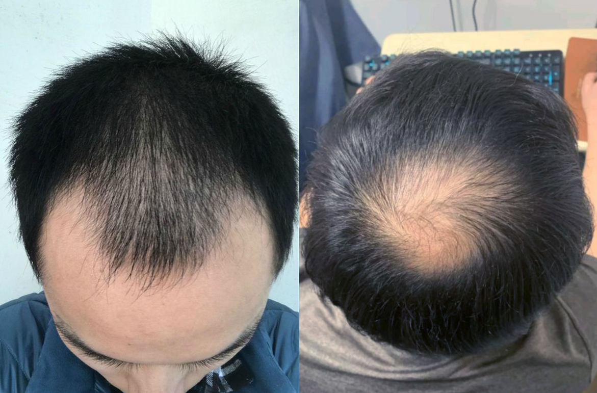 男性遗传脱发脂溢性脱发的治疗方法头顶脱发