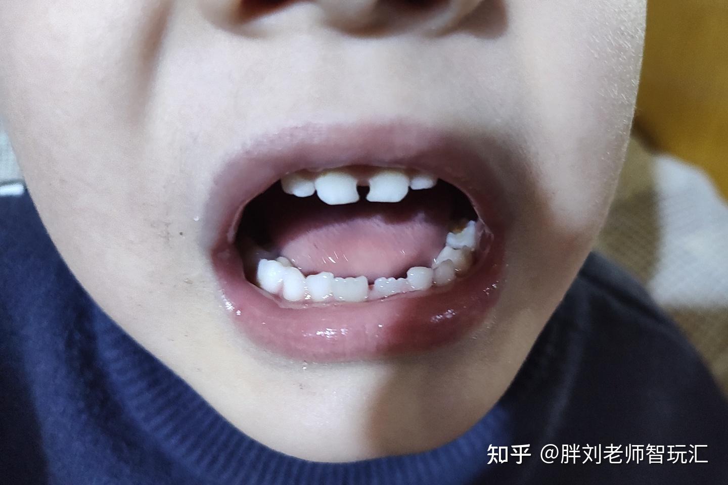 深圳儿童龋齿牙疼怎么治疗_深圳爱康健口腔医院