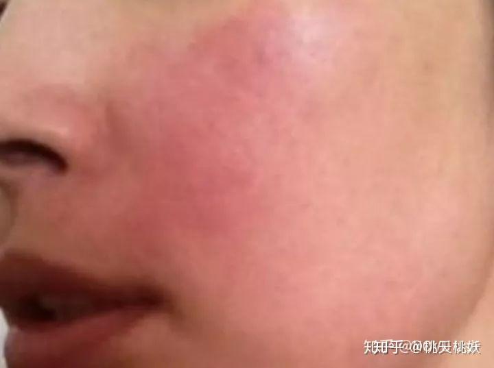 皮肤过敏怎么办