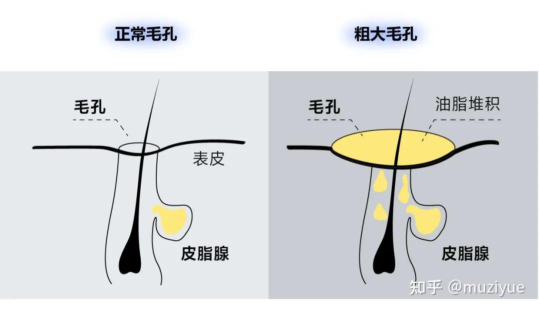 油脂型一般出現在青春期,由於油脂分泌旺盛堵塞毛孔,沒及時清理汙垢