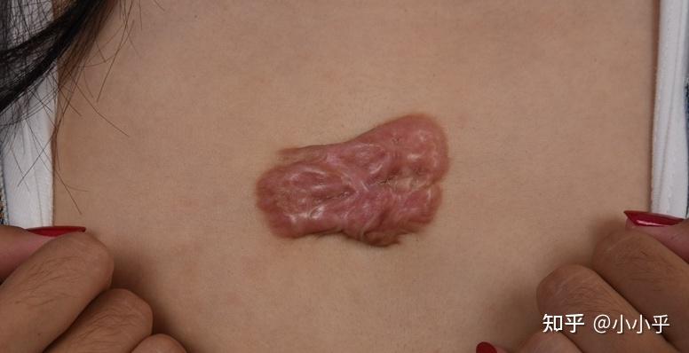 疤痕疙瘩复发会有什么样的表现