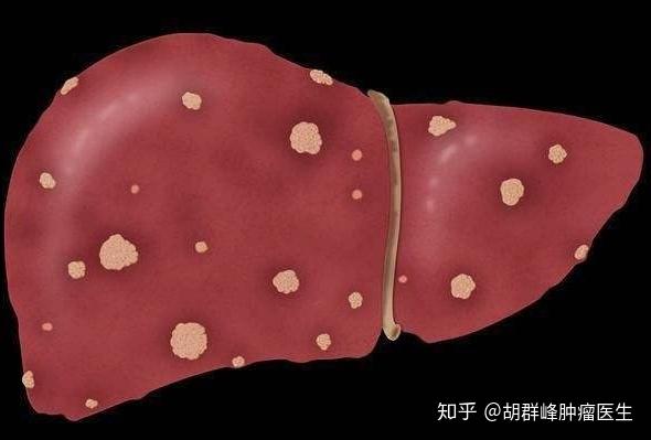 29岁年轻人患肝癌晚期定留意肝癌这5个早期信号