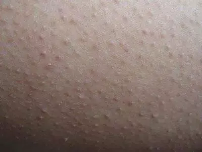鸡皮肤可以激光嫩肤去除吗(鸡皮肤可以激光嫩肤去除吗图片)