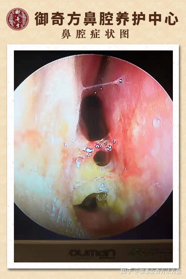 求助,萎缩性鼻炎可以治疗么?