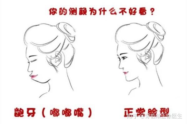 教你分辨假凸嘴和真凸嘴的区别,正确鉴定自己的嘴凸不凸 - 知乎