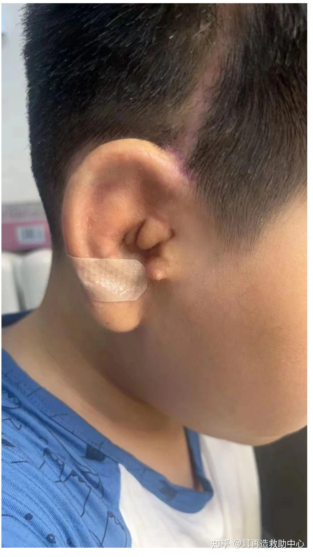 成人の副耳の手術です！ | 北千住静脈瘤クリニック