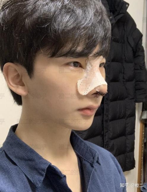 男生隆鼻审美功课怎么找到适合自己的隆鼻模板(内附案例)
