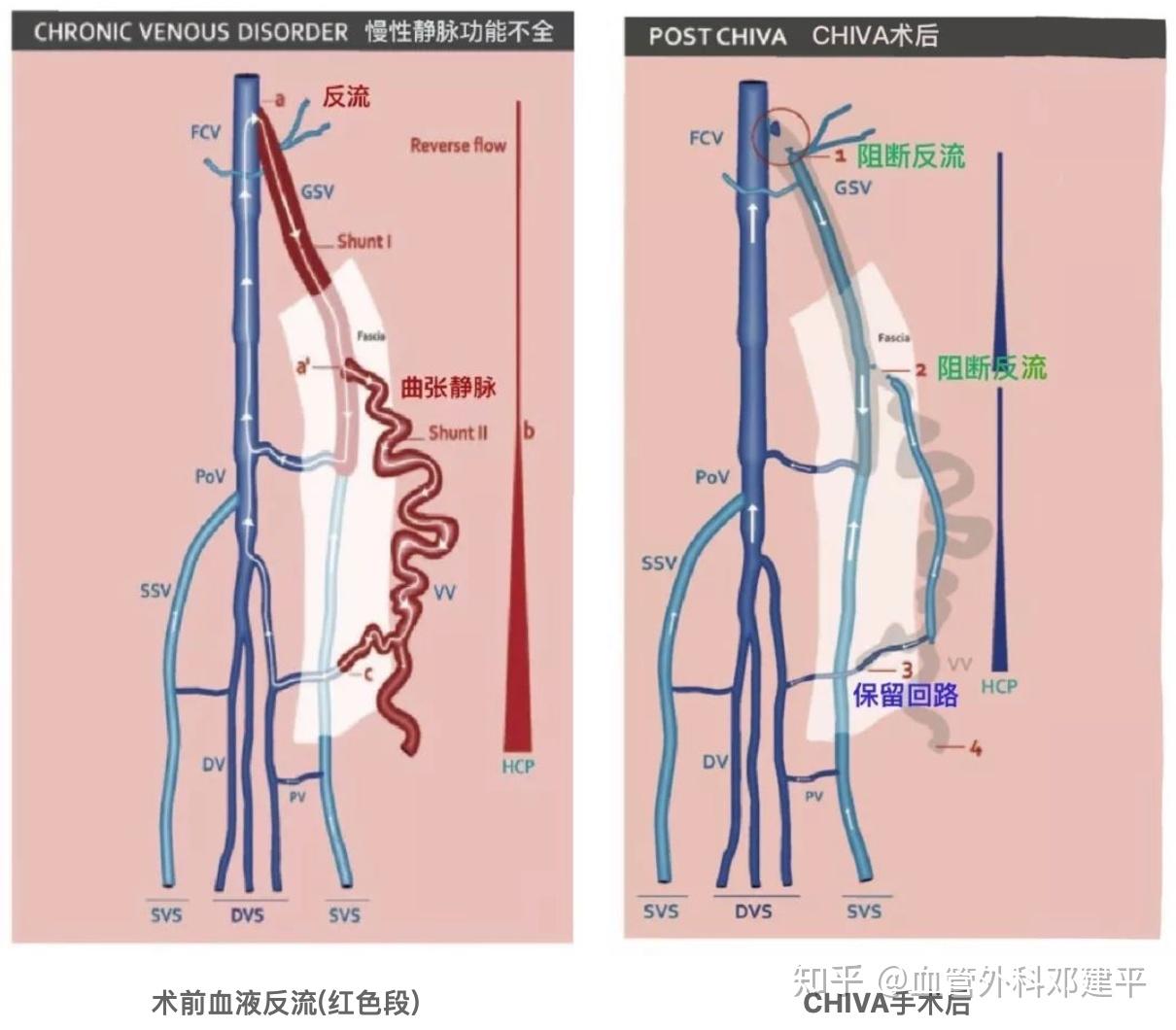 正常腹壁静脉血流图图片