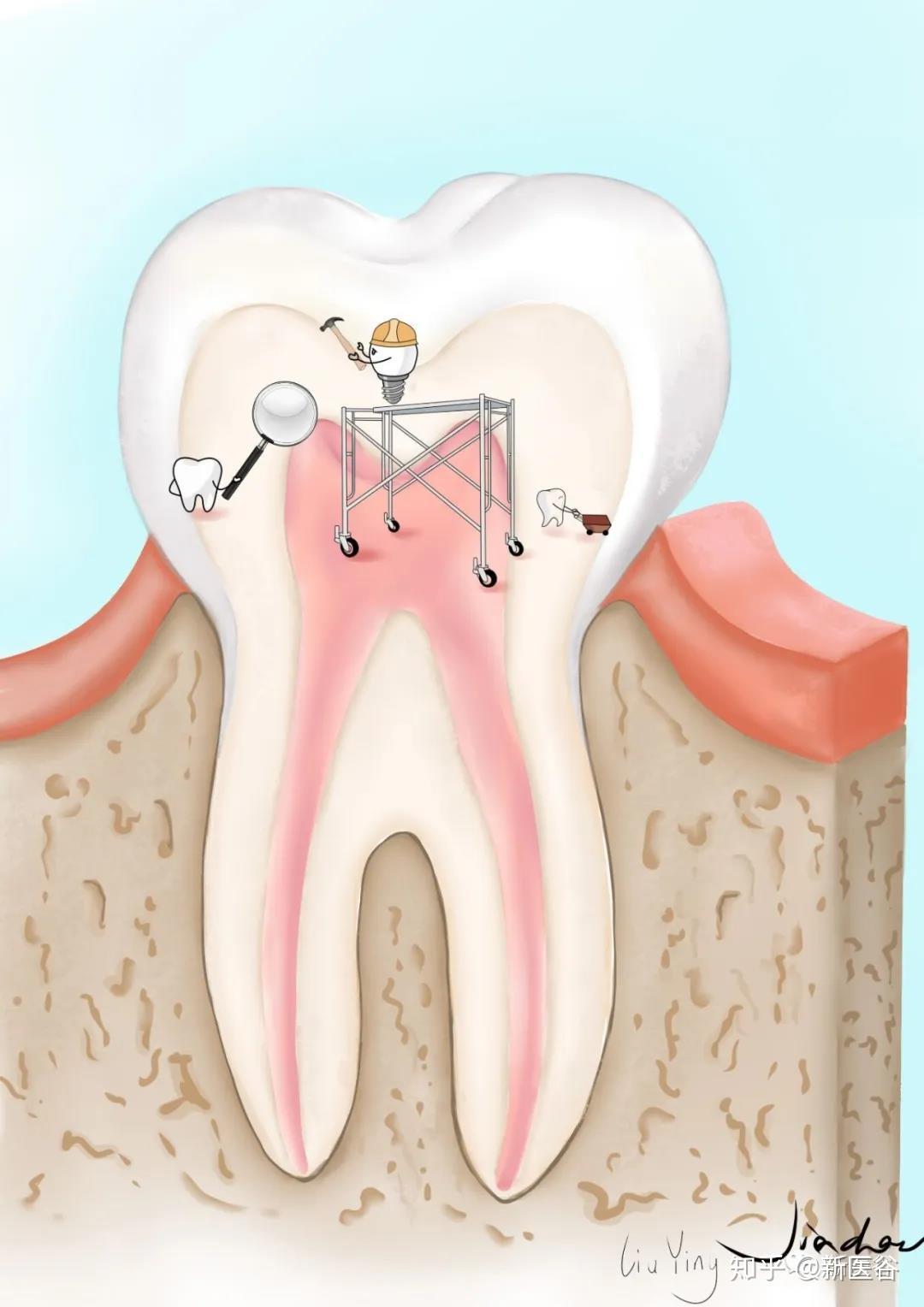 牙髓钙化之髓石 - 知乎
