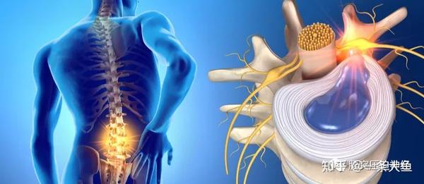 压迫硬膜囊是什么意思 腰椎硬膜囊受压要手术吗 腰5骶1左侧侧隐窝狭窄