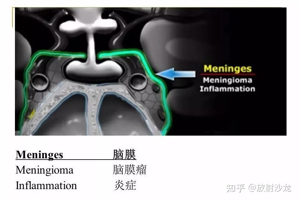【收藏】蝶鞍及鞍旁区域解剖 - 知乎