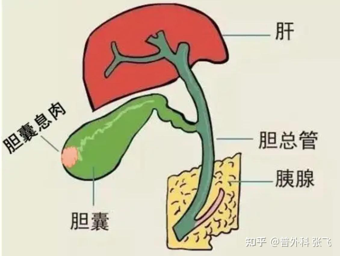 胆囊息肉长在哪里图片