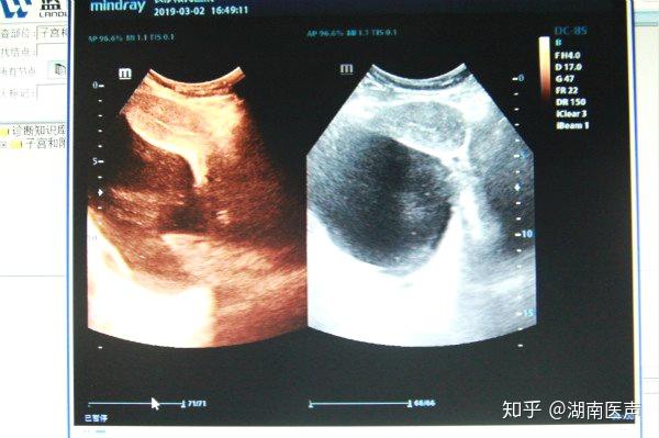 刘女士体内的右侧输卵管和卵巢系膜周边竟然有一个18厘米大的囊性包块