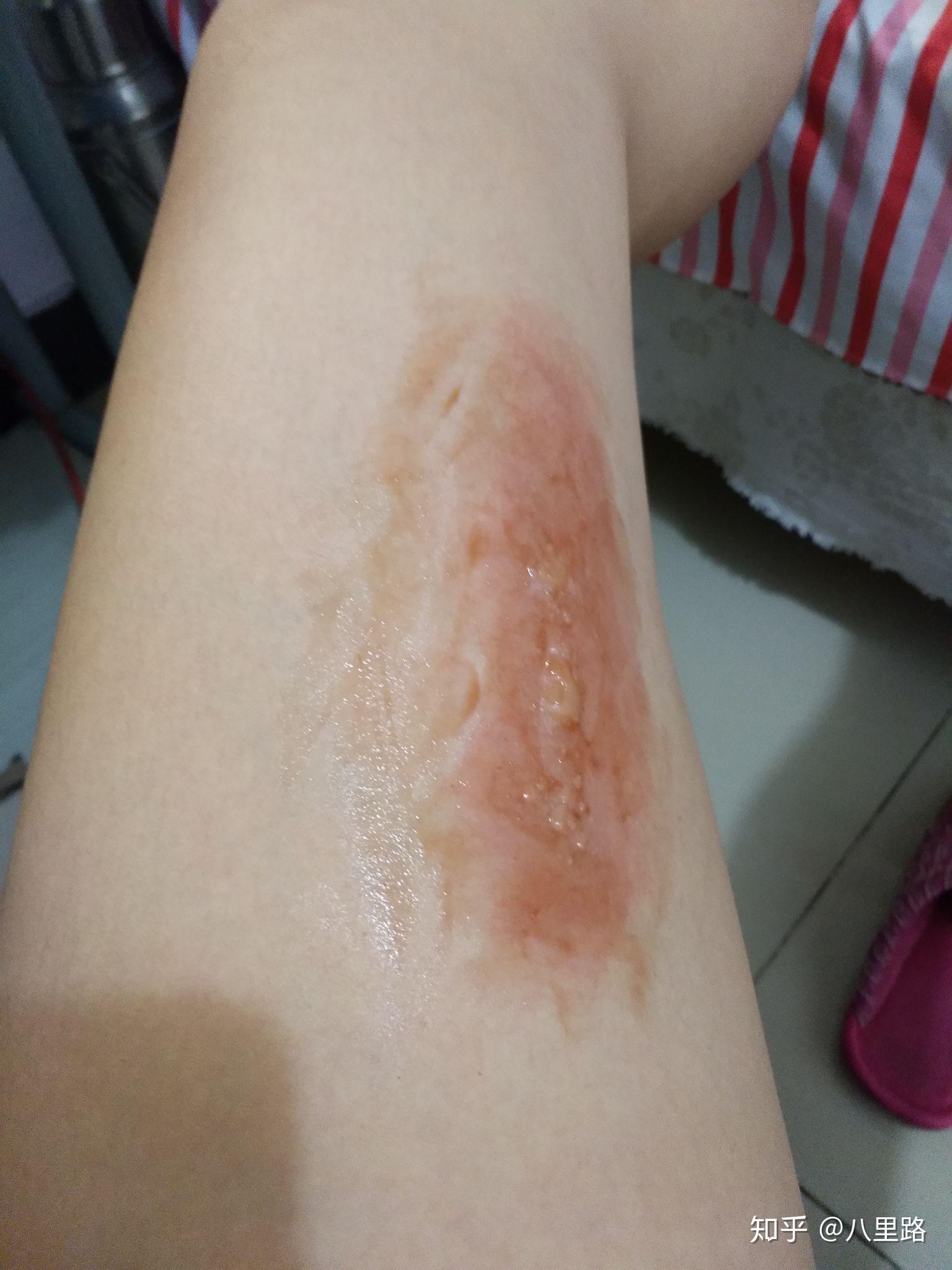 大腿烫伤4个月