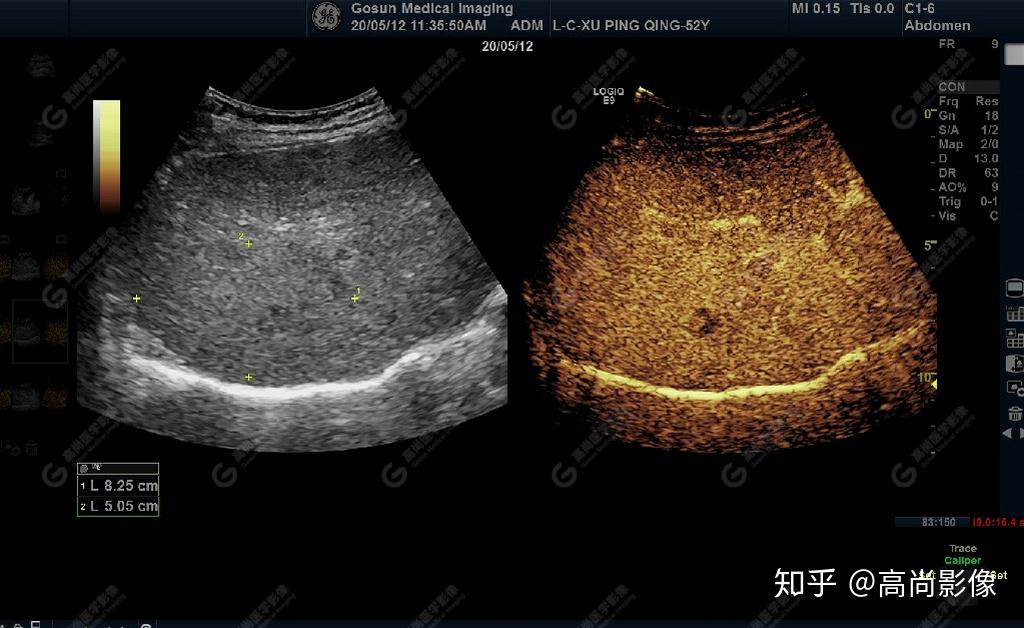 其內部無明顯血流超聲提示肝硬化聲像圖表現門靜脈內實性佔位病變