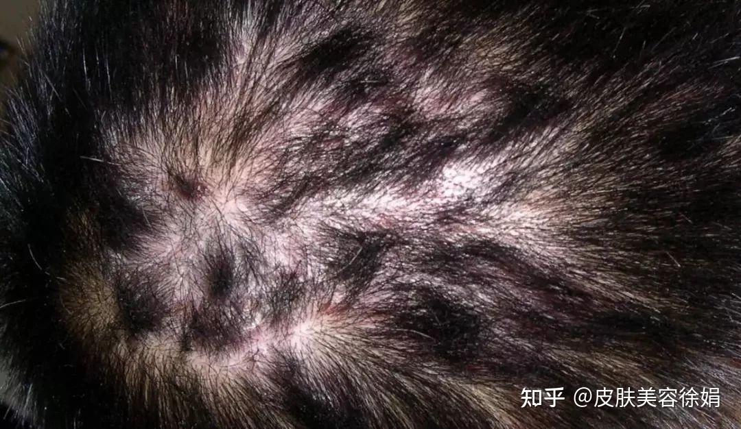头皮脂溢性皮炎这么治,就不会走到脱发那一步 - 知乎