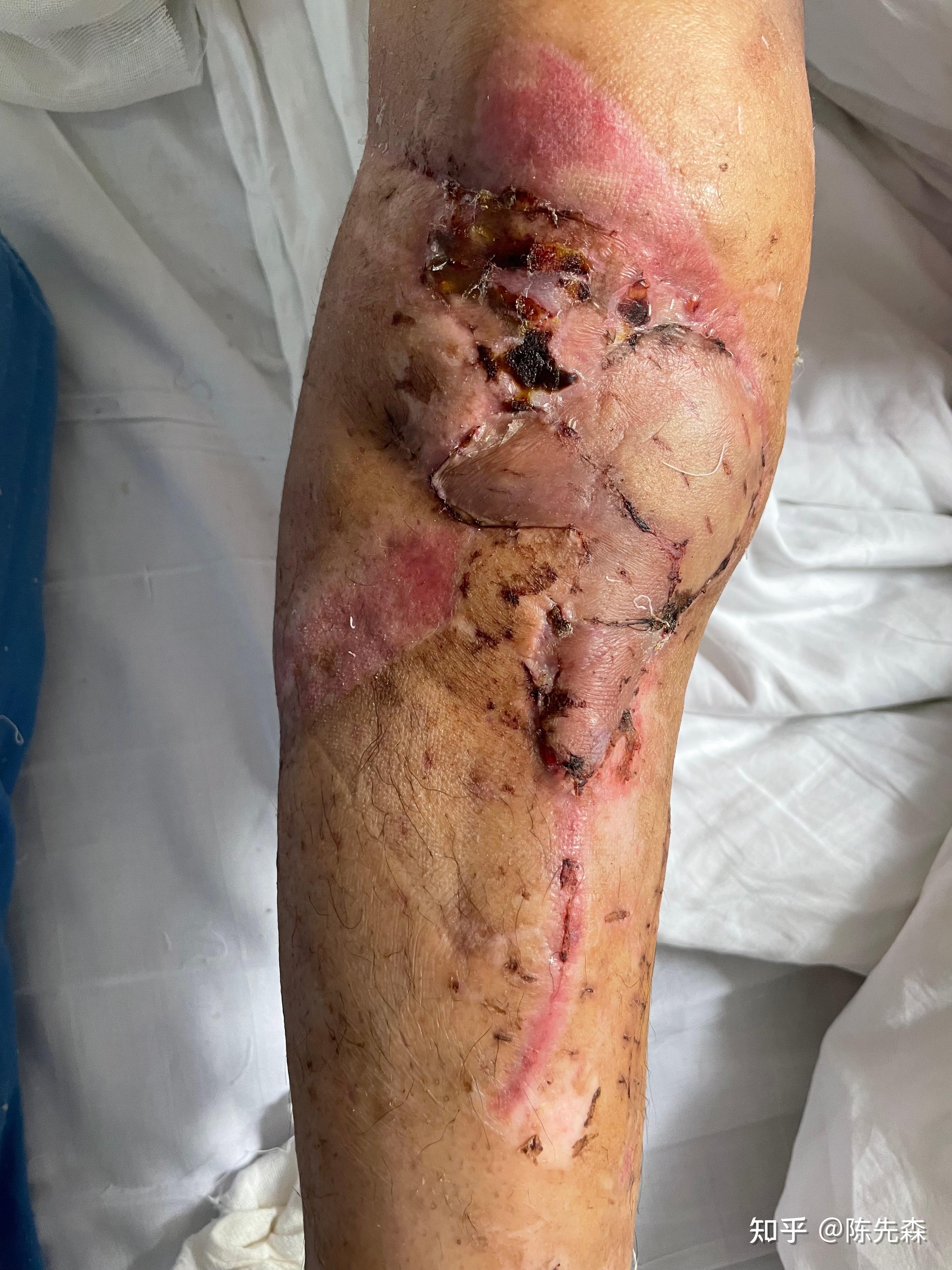 记录自己胫骨平台开放性骨折并且严重骨缺损的治疗经历