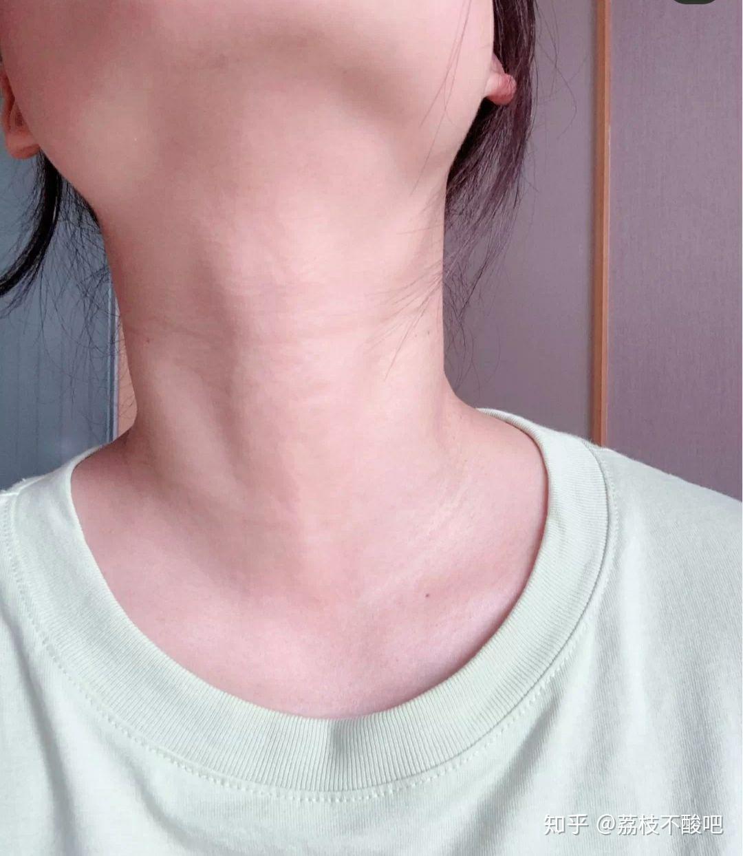 脖子肉堆积颈纹严重图片