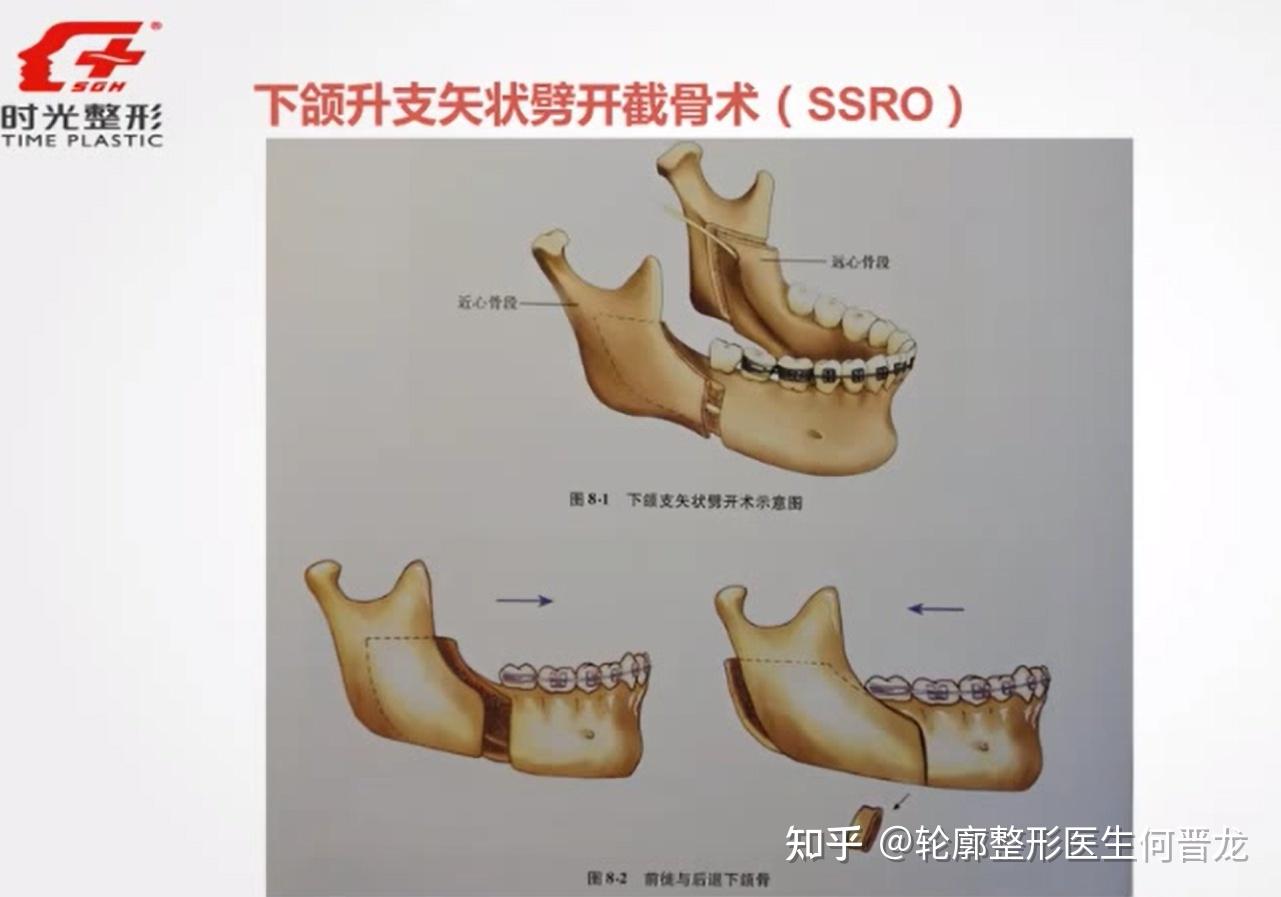 l型截骨术其中上颌lefort l型截骨术,上颌前部骨切开术 amo,下颌升