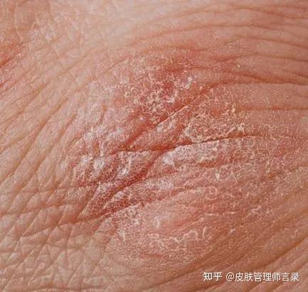 皱纹色斑该怎么去除 知乎