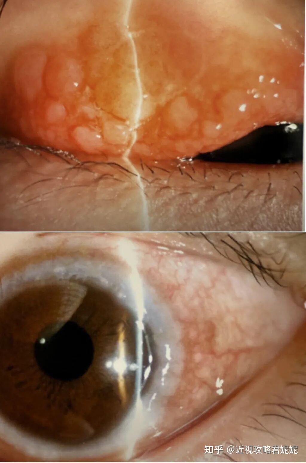 不是所有的眼红眼痒都是疲劳——科学认识并管理过敏性结膜炎 - 知乎