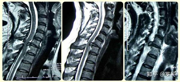 颈椎突出严重吗 我是c3 6突出 可能会有那些异常 知乎