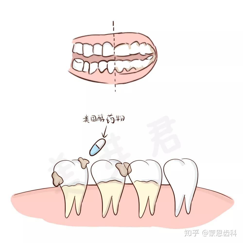 30做牙齿矫正还有用吗牙齿会提前松动和反弹吗