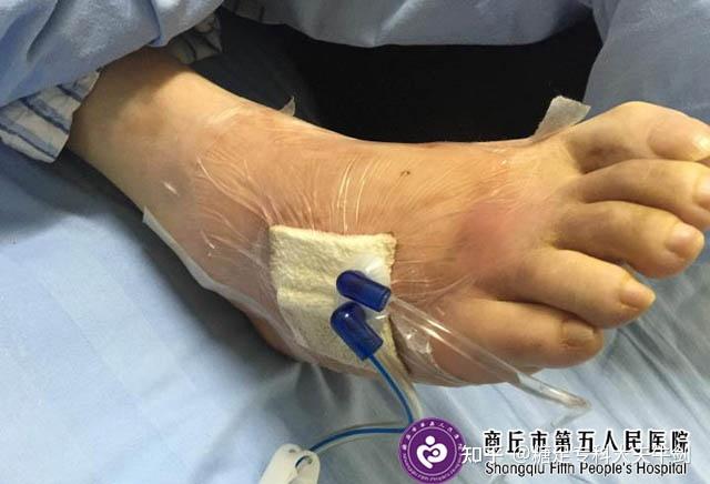 封闭负压引流治疗糖尿病伤口感染效果好吗