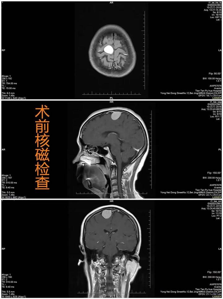 病例分享｜纤维型脑膜瘤一例 知乎