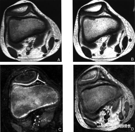 髌骨软化核磁共振图像图片