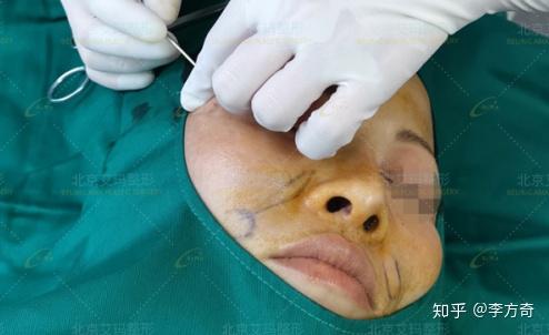 取出物呈淡黄色,乳液状物质,并且有不可稀释的结节出现(类似于死肉块)