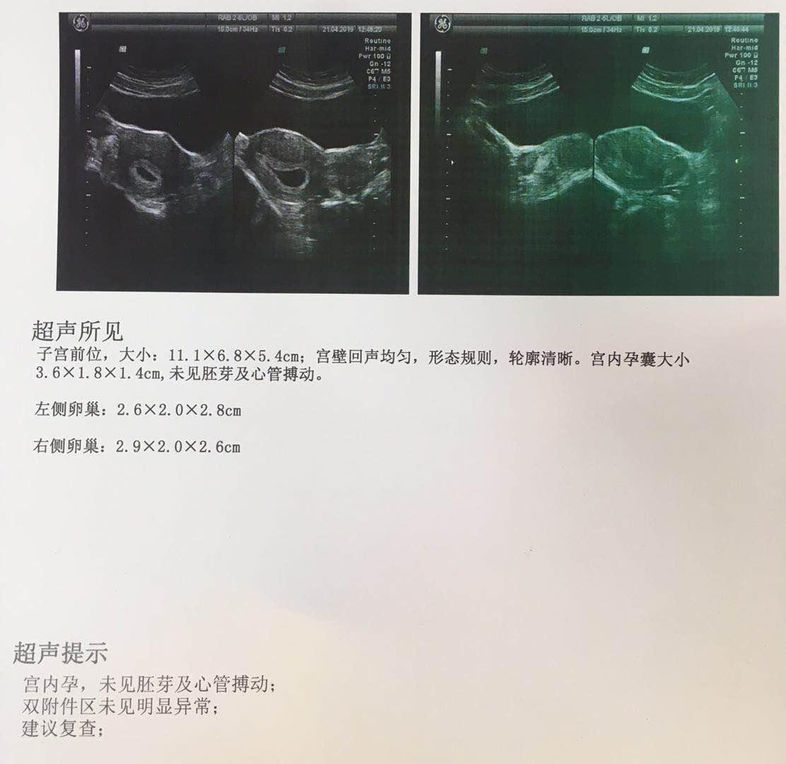 医生说 要是下周还看不见胎心胎芽 就给我开人流单子 知乎 医生说 要是下周还看不见胎心胎芽 就给我开人流单子 知乎