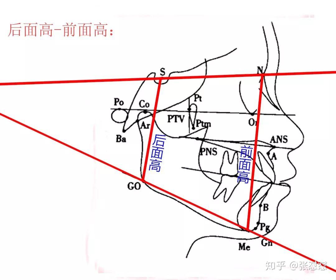 牙齿矫正期间的高角和低角面型是如何判定的