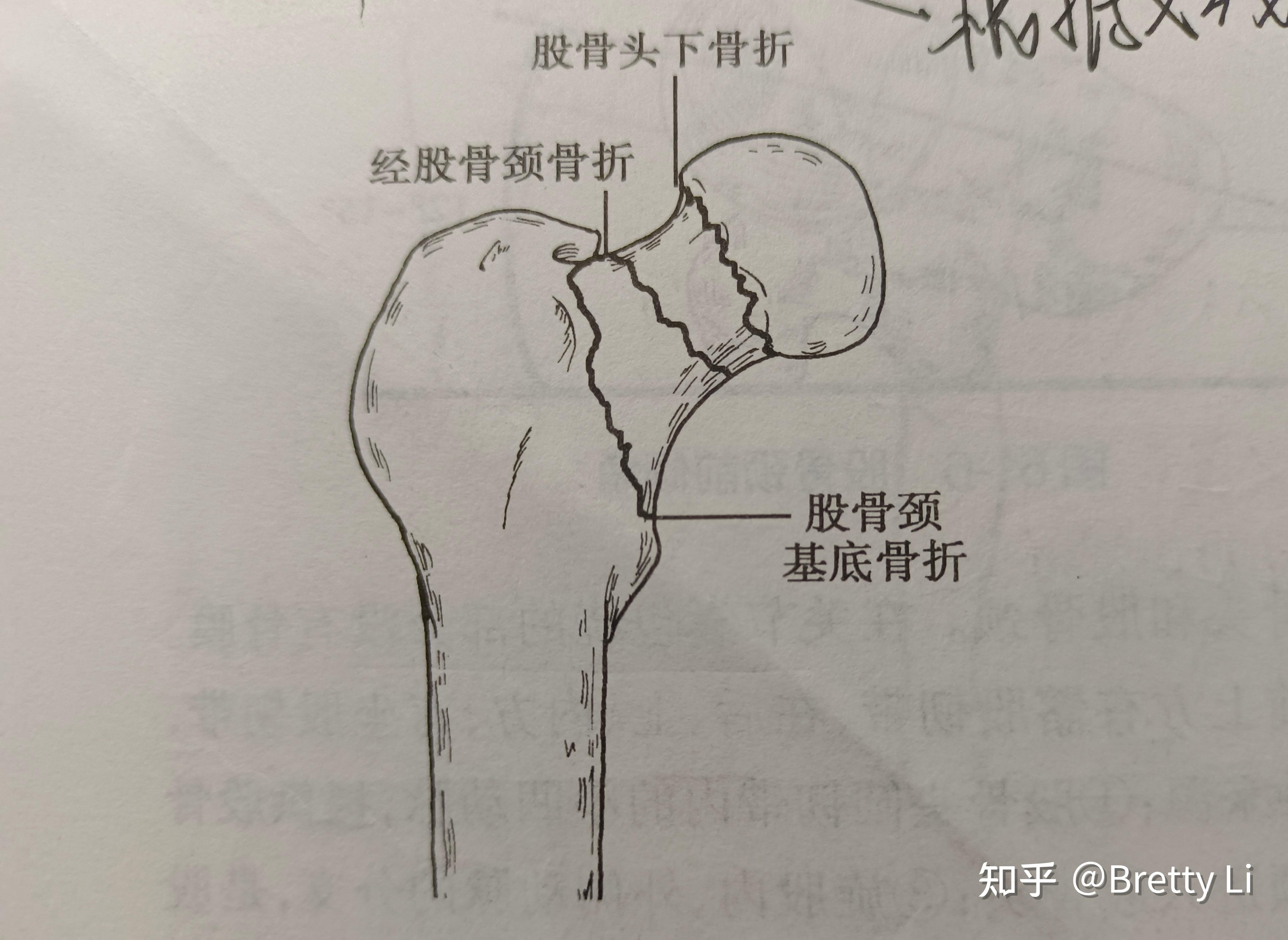 股骨颈骨折基底型图片