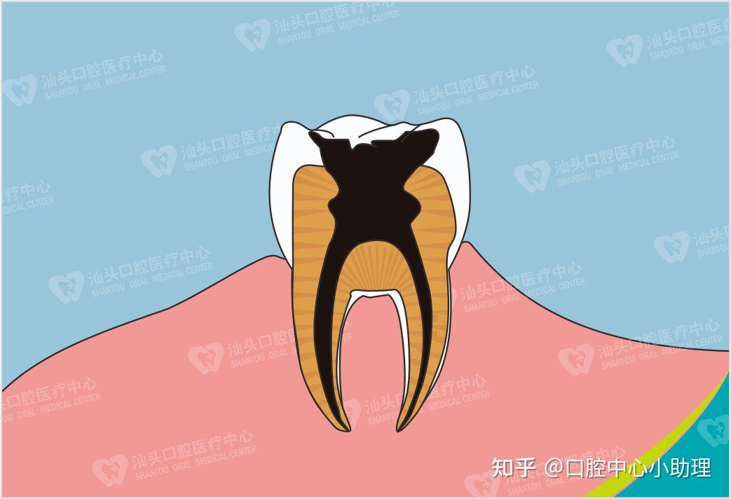 淺齲只蛀到牙釉質,一般沒有明顯症狀.