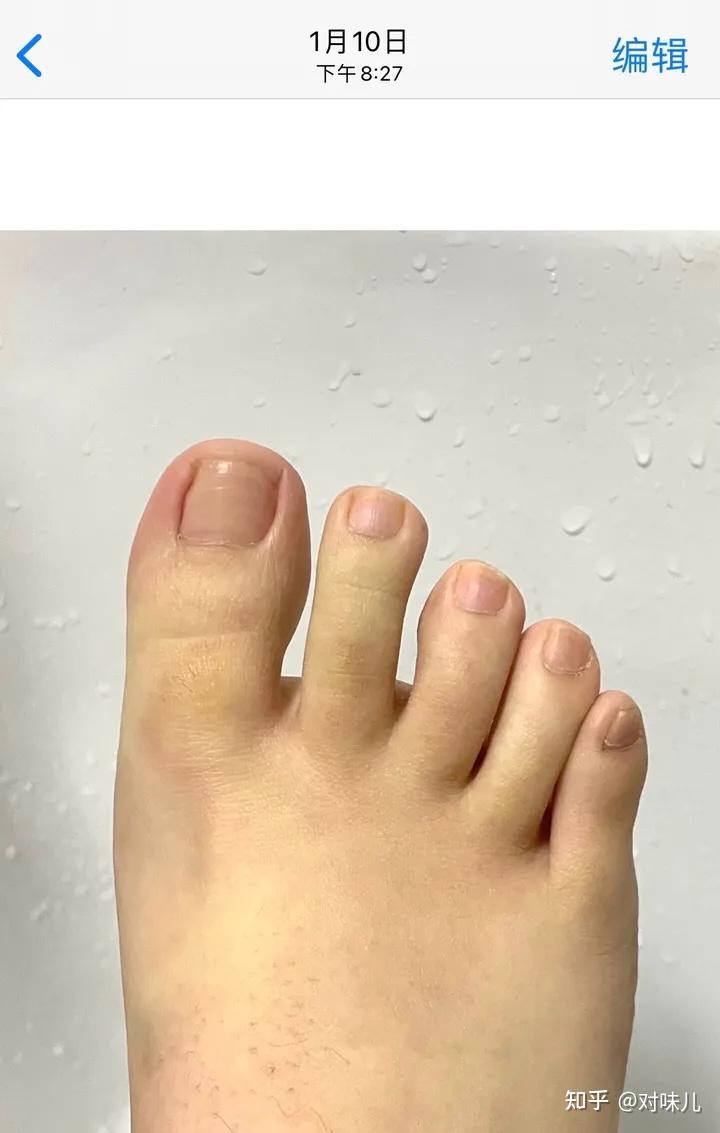 脚趾甲发灰发黄增厚分裂用什么才能好