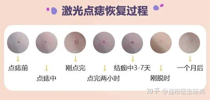 2.激光点痣可清除药物和其他方法未能祛除的色素.3.