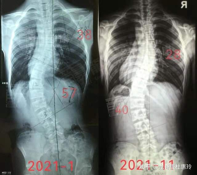 14岁侧弯男孩,治疗十个月后57°减至40°,体表改善效果明显! - 知乎