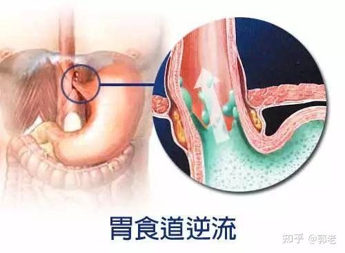 流性食管炎a级严重吗 治疗方法主要有三点 知乎