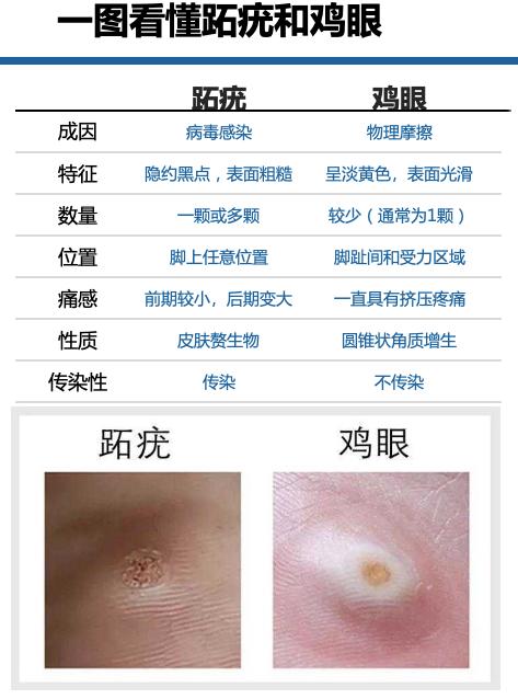 跖疣传染吗怎么分辨鸡眼和跖疣有什么方法