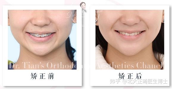郑州隐适美认证医师曹甜深覆合矫正时平导戴用的科普