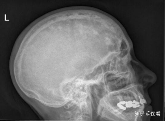 paget是什么病呢