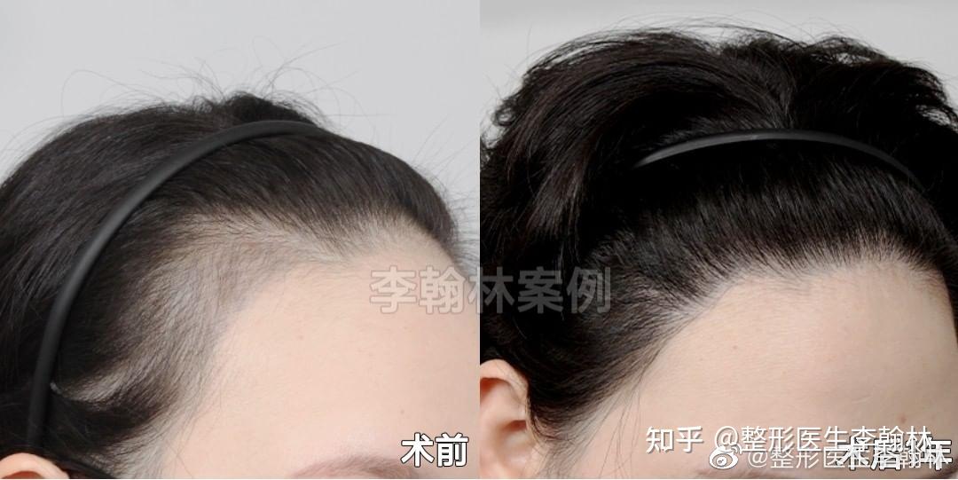 常见发际线后移的原因 - 知乎