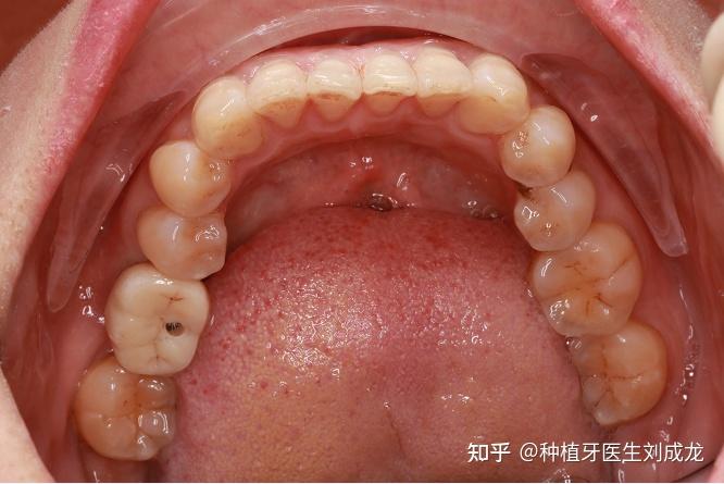郑州瑞士iti种植牙医生刘成龙41岁女士磨牙区单颗种植案例